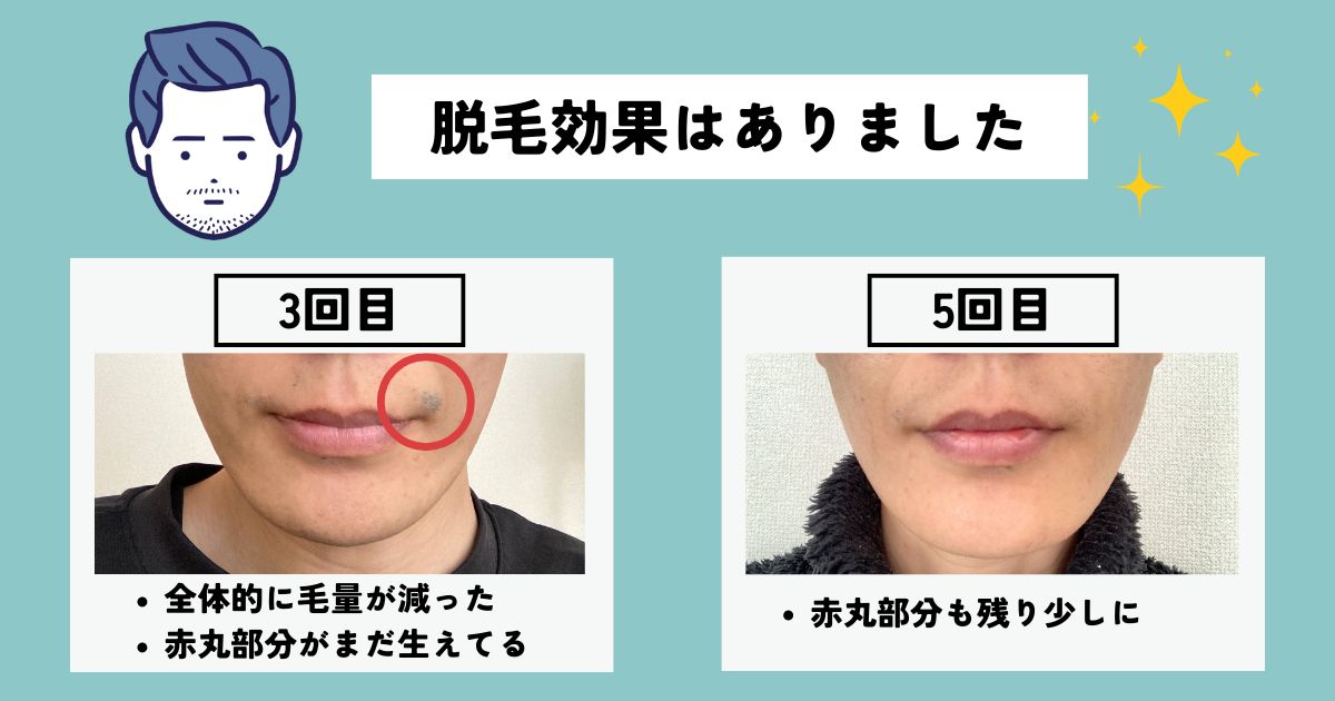 メンズエミナルの脱毛効果はあった？【結論、ありました。】